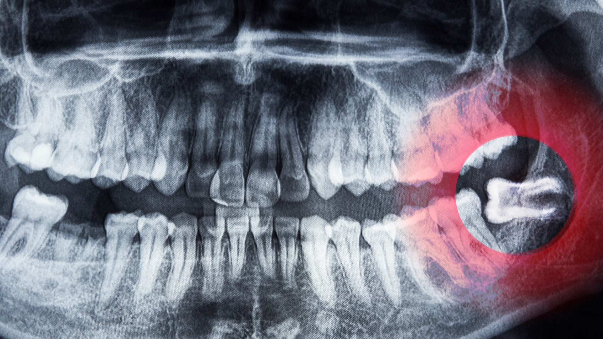 Everything You Need to Know About Wisdom Tooth Extraction