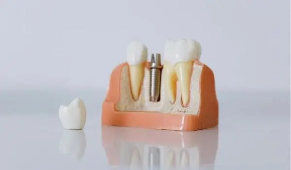 Dental Implants Manchester – Comprehensive Guide to Benefits, Costs, and Procedure