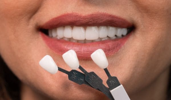 What Are Veneers?