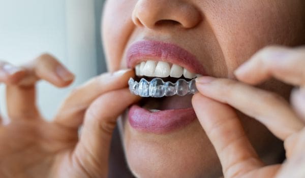 How Does Invisalign Work?