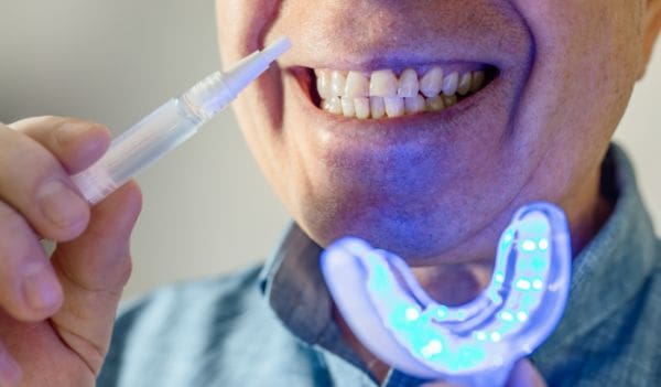 How Good Are Teeth Whitening Kits?