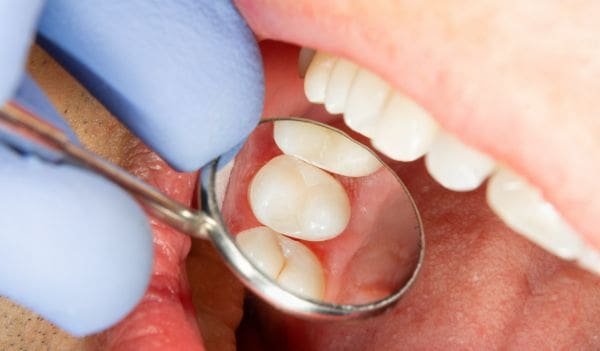 Eight Options for Replacing or Restoring Bad Teeth