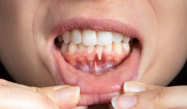 What Is Gum Disease And Can It Be Reversed?