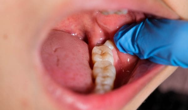 Everything You Need to Know About Wisdom Tooth Extraction